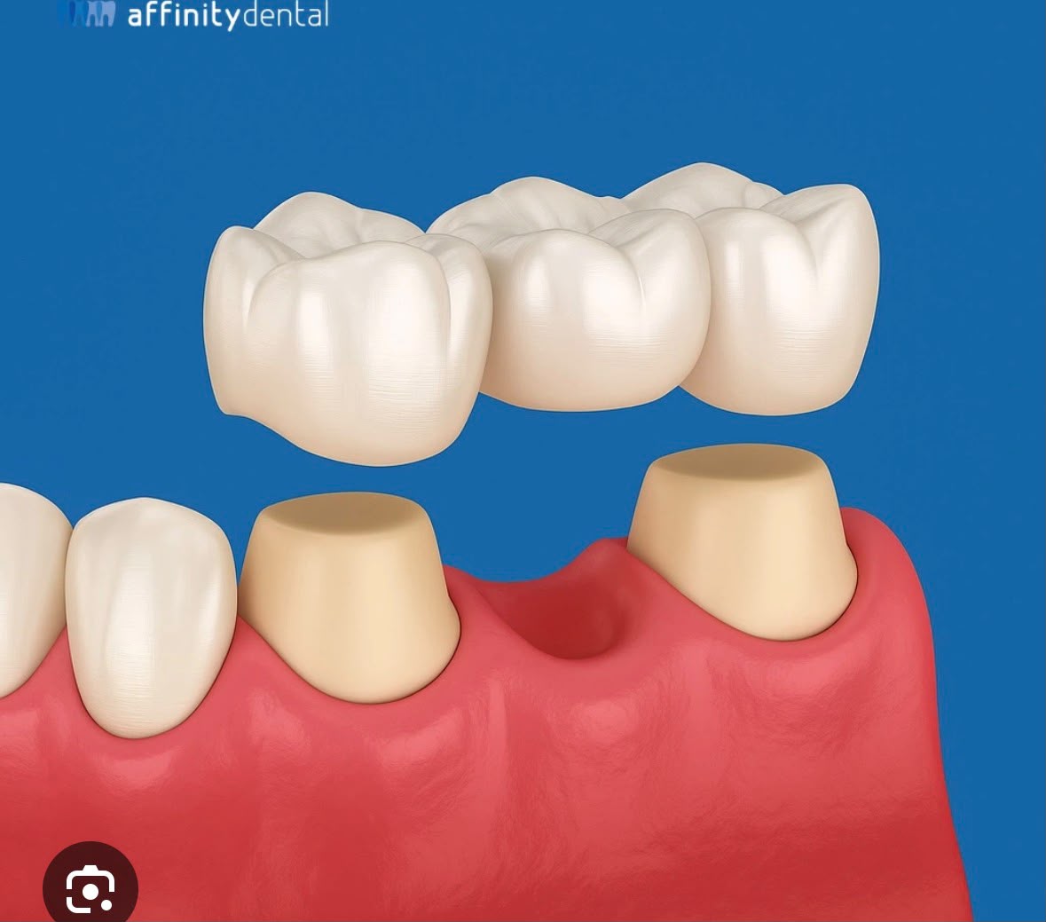 Modello di corone dentali in zirconia